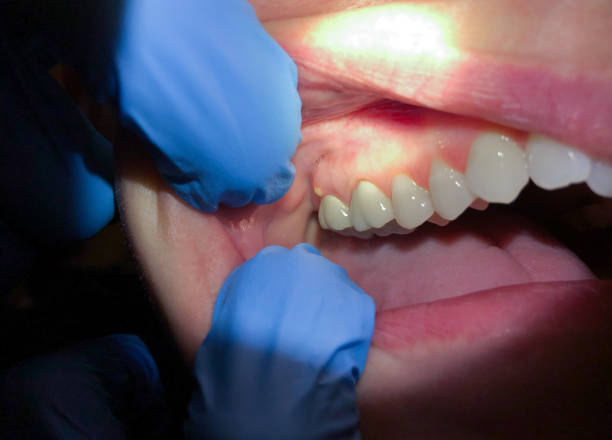 Best Tooth Infection Emergency Dentist  in Guttenberg, NJ